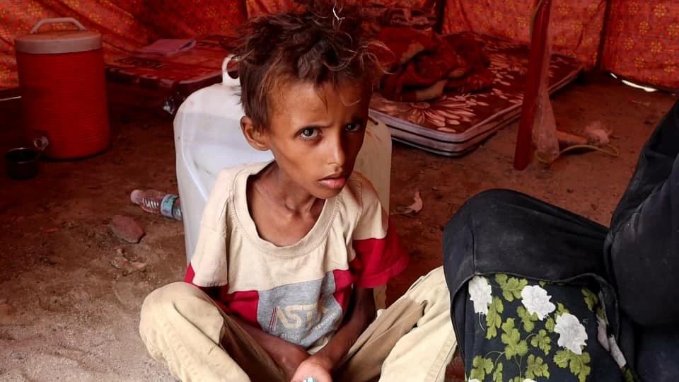 UNICEF Says Fighting In Yemen Disrupts Healthcare, Raises Acute Malnutrition Among Children