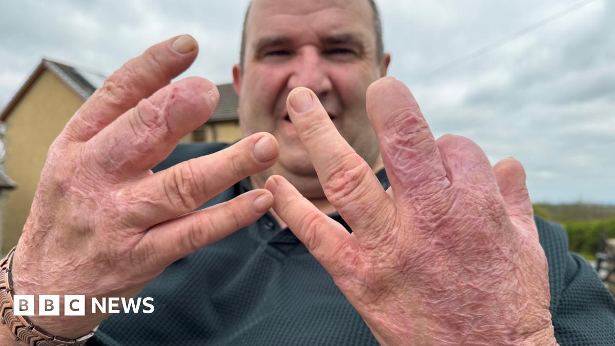 'I was given a choice - keep my legs or keep my life' - the sepsis patient who lived