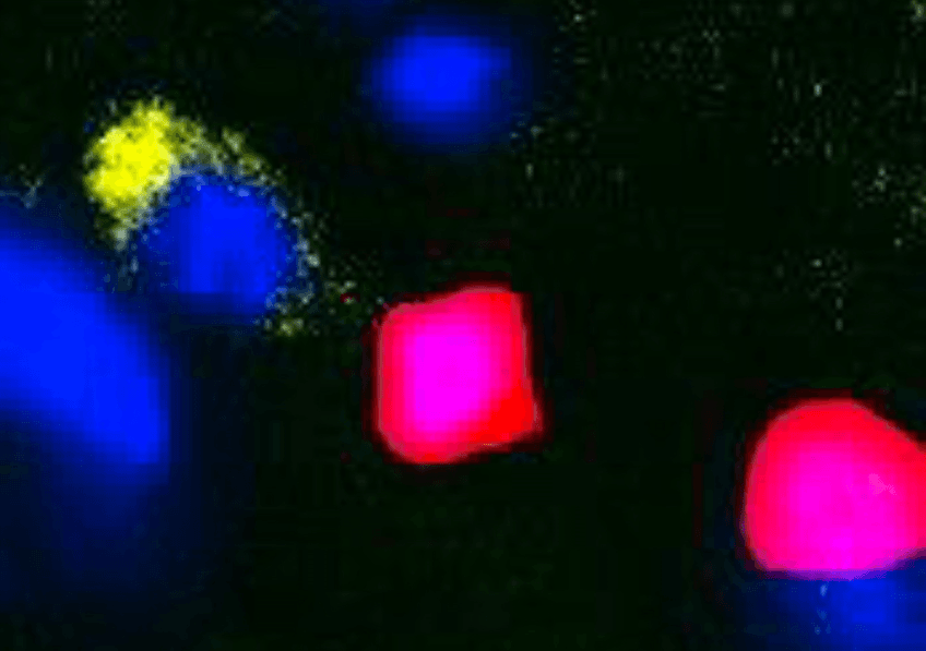 Kyverna’s CAR-T Therapy Miv-cel Targets Stiff Person Syndrome for Regulatory Approval