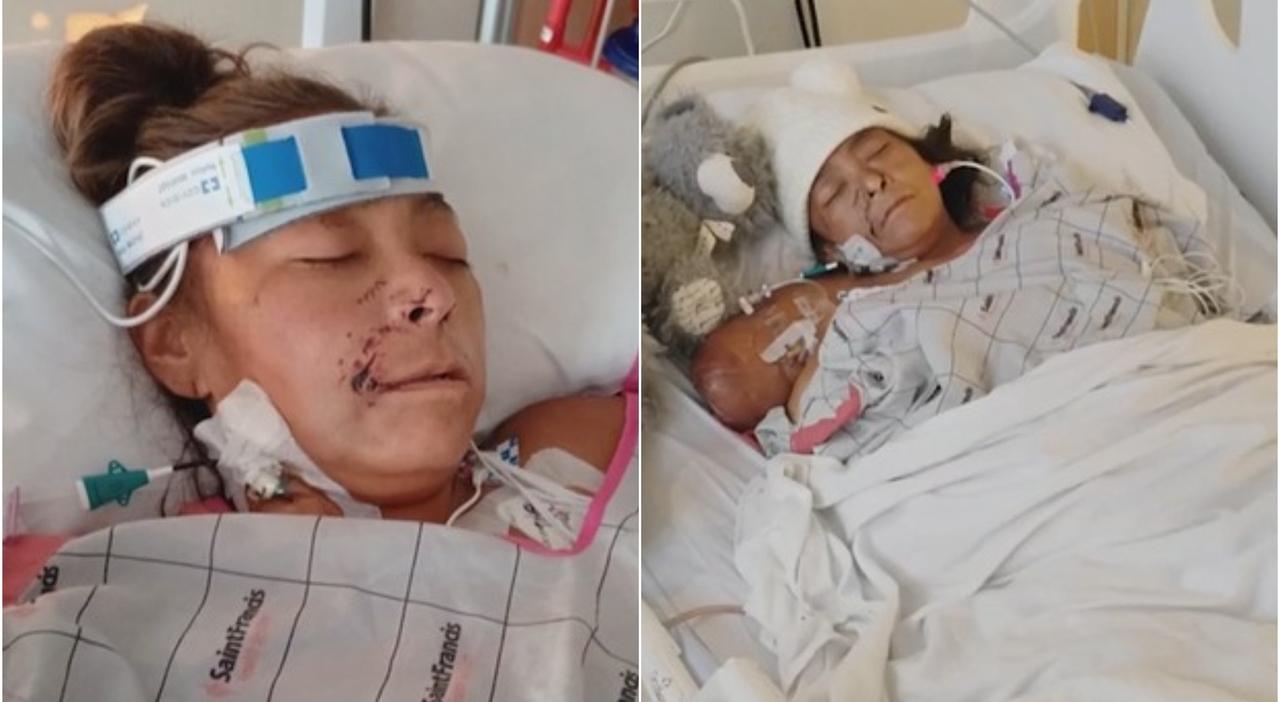 Two Pit Bulls Attack Janelle Scott in Okmulgee, Oklahoma, Forcing Amputation of All Four Limbs